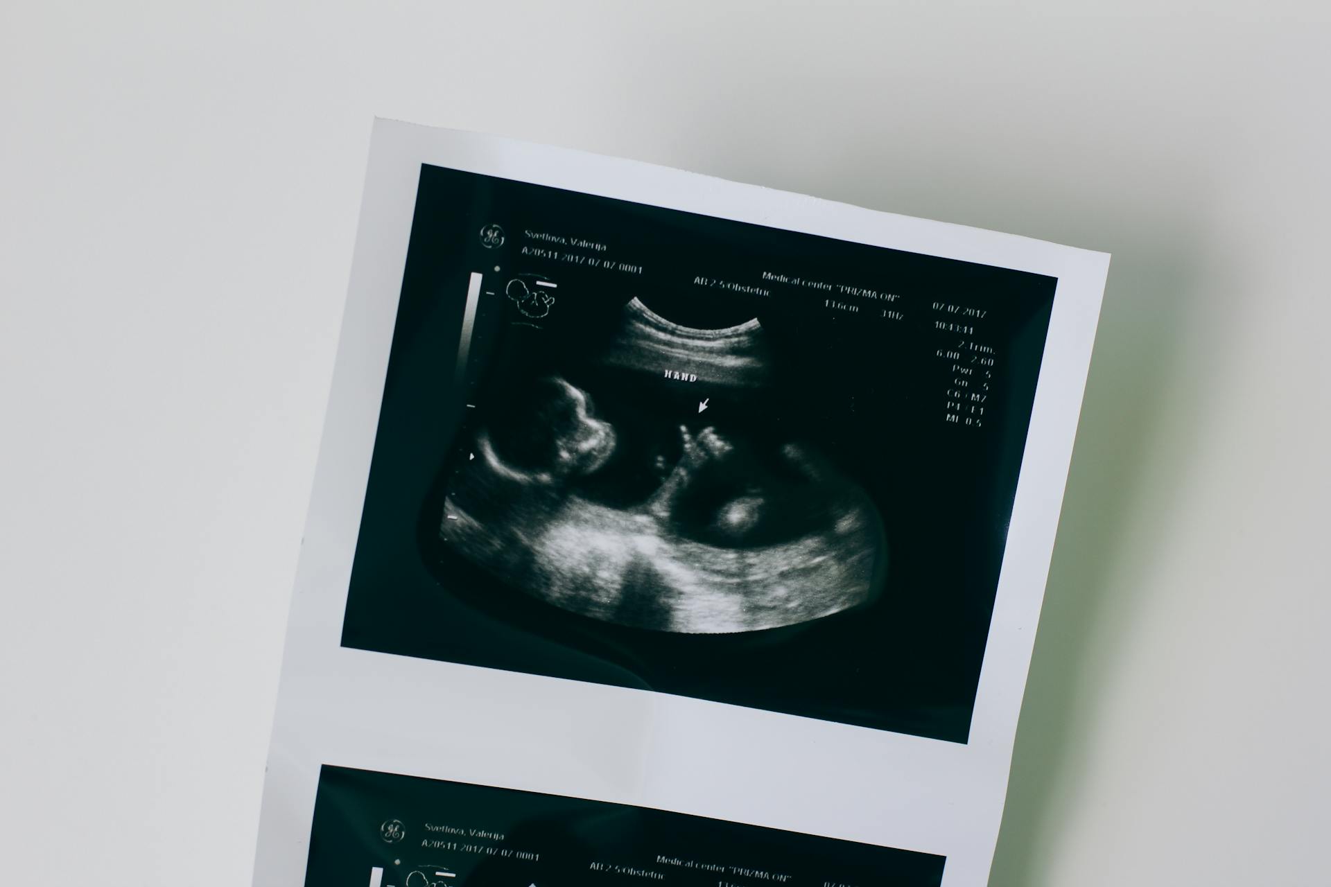 Close-up shot of a sonogram | Source: Pexels